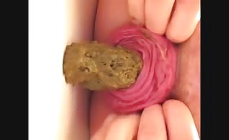 Anal prolapse while pooping